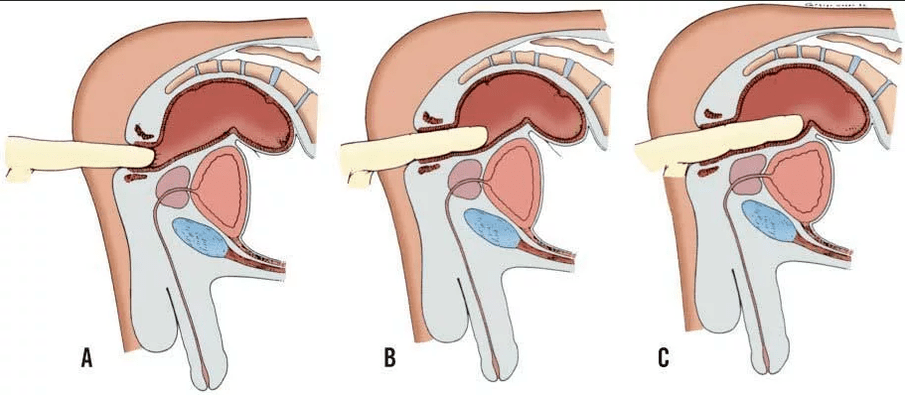 Rectal fingers